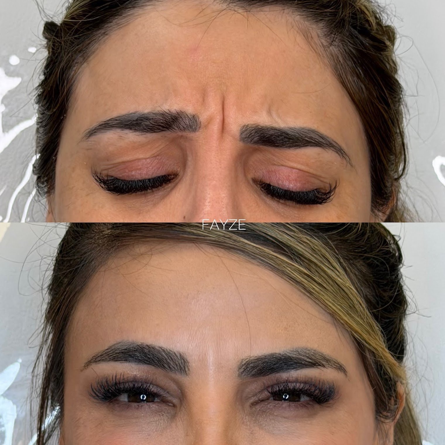 Botox frente FAYZE
