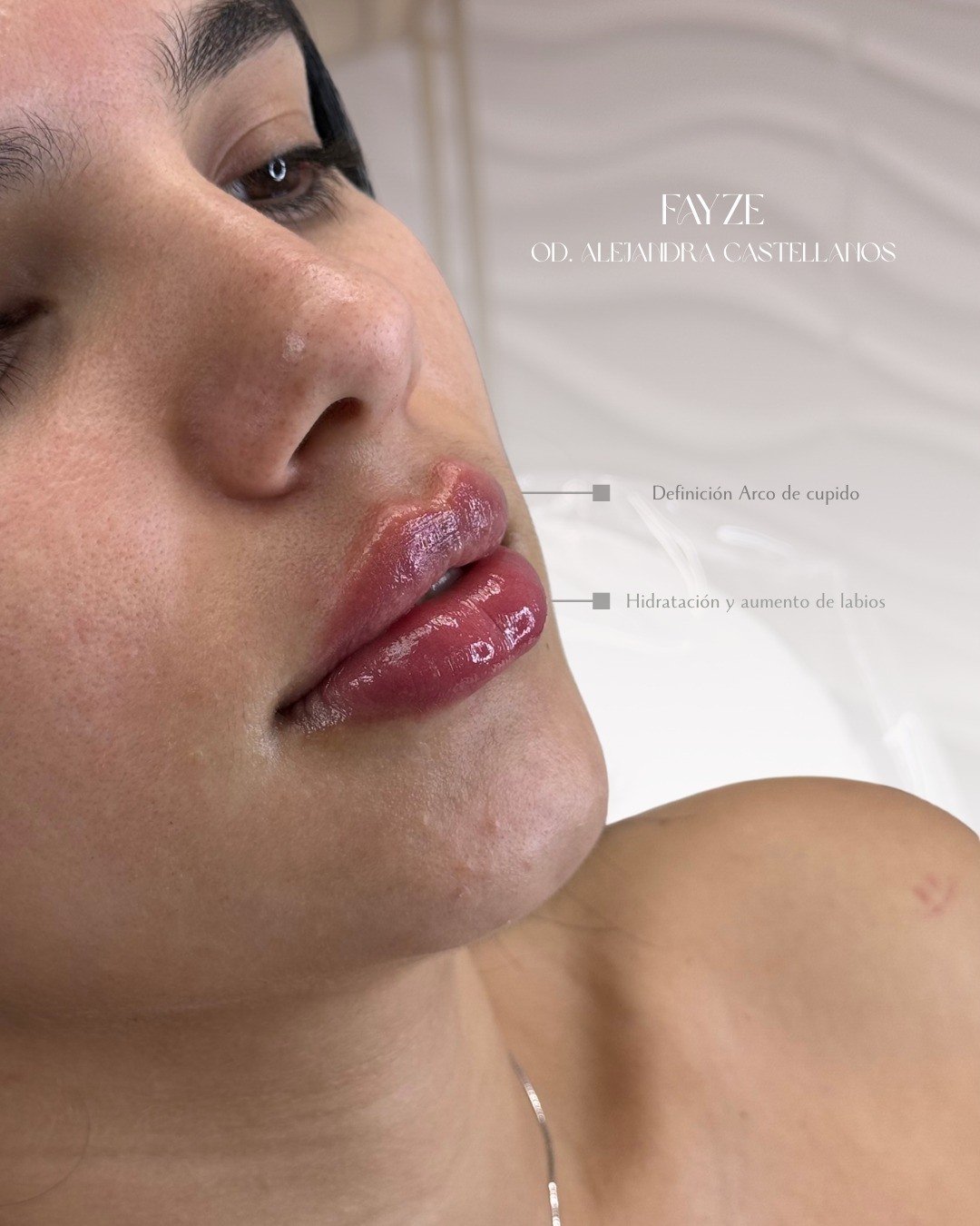 Botox líneas de expresión FAYZE