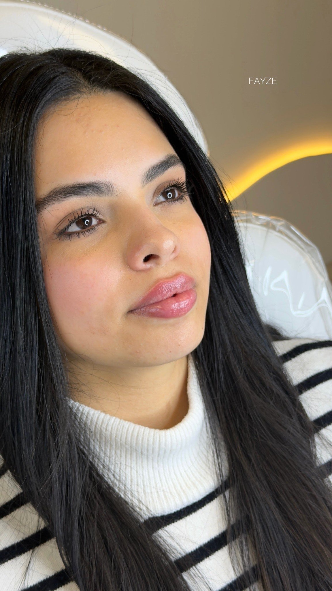 Antes después labios perfil FAYZE